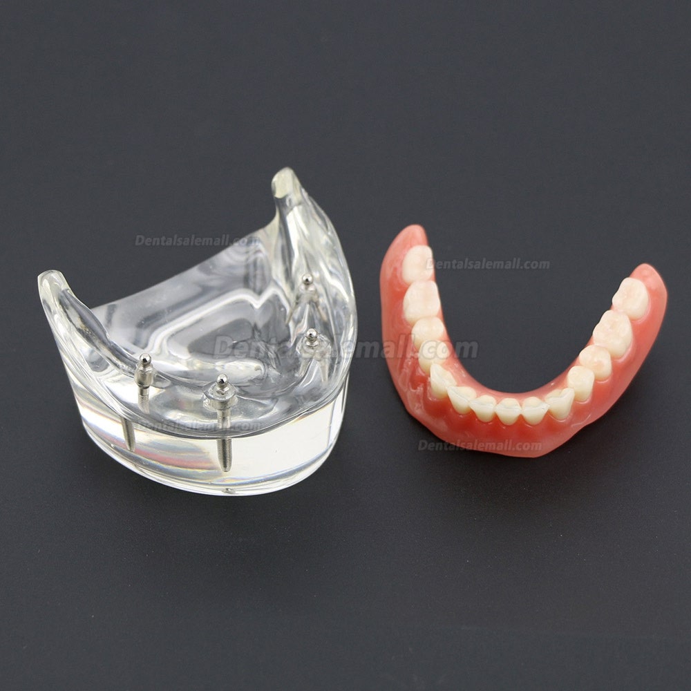 Dental Lower Teeth Demo Study Model 6002 02 Overdenture Inferior 4 Implants